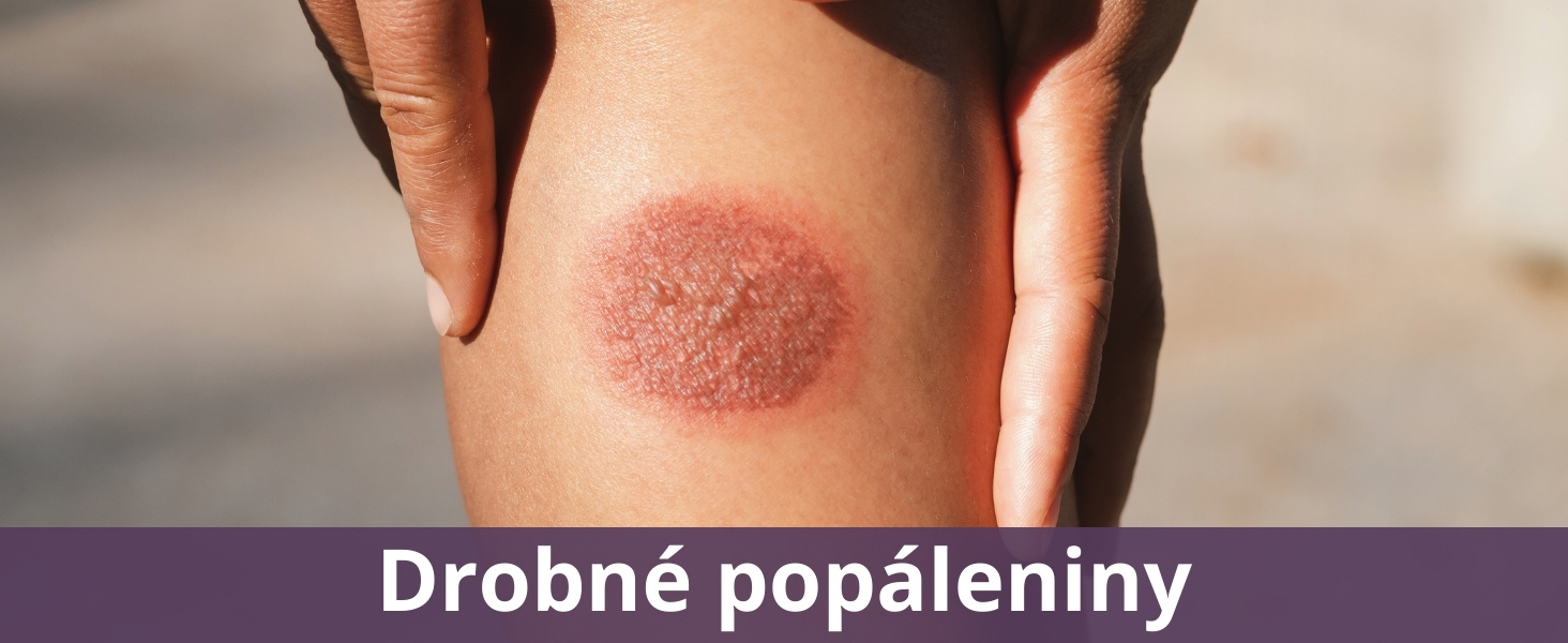 Drobné popáleniny