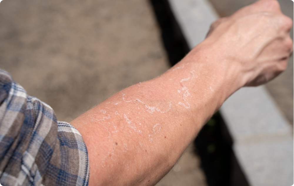 Ako olej na podráždenú a suchú pokožku