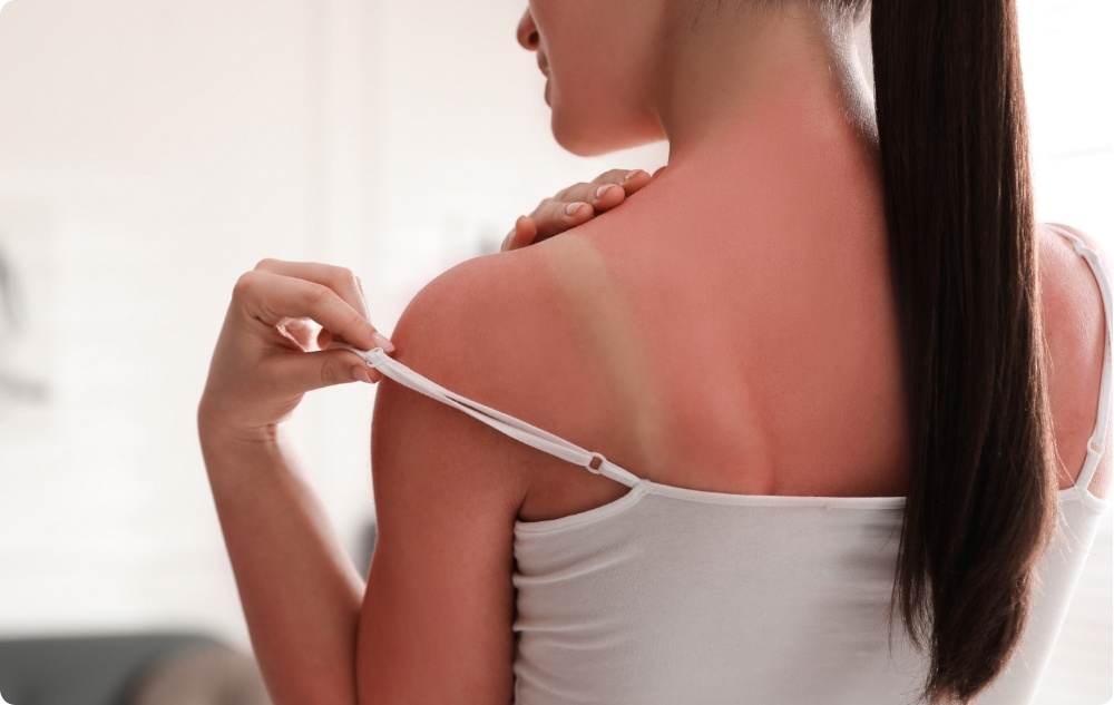 Ako upokojujúce mlieko po opaľovaní